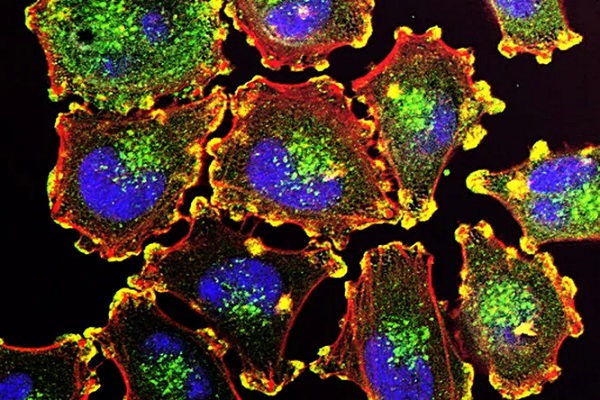 Прорыв в диагностике онкологии: новый метод позволяет обнаружить раковые клетки еще до появления опухоли