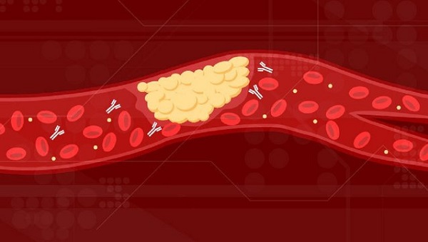 Сгустки крови от COVID-19: обнаружили новую причину образования тромбов в сосудах при коронавирусе
